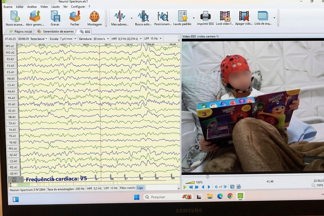 Monitoramento de Vídeo-EEG com registro das ondas cerebrais e filmagem sincronizada do paciente